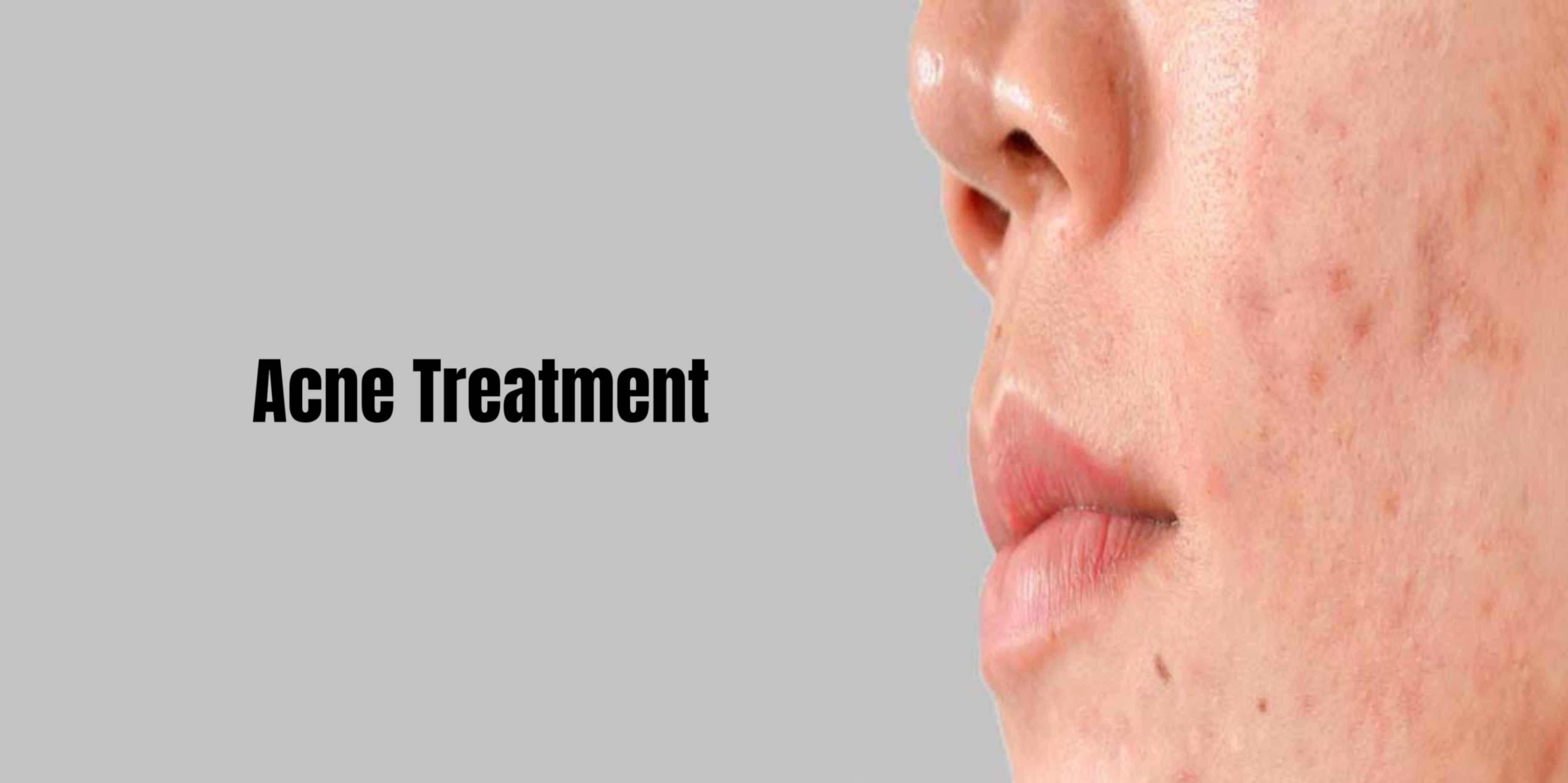 Best Acne Treatment In Bangalore At Charma Clinic